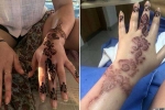 henna burns treatment, how long does black henna last, henna tattoo cause aussie woman to almost lose her hand, Tattoos