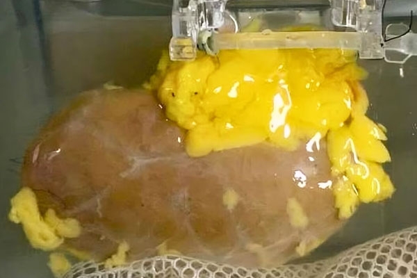 Scientists Develop 'Universal Kidney': Transplanted to any Blood Group Scientists Develop 'Universal Kidney': Transplanted to any Blood Group