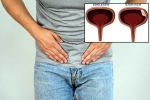 Bladder Cancer symptoms, Bladder Cancer, why is bladder cancer common in men, Bladder cancer