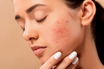 skin care products, dermatologist, 10 ways to get rid of pimples at home, Natural glow